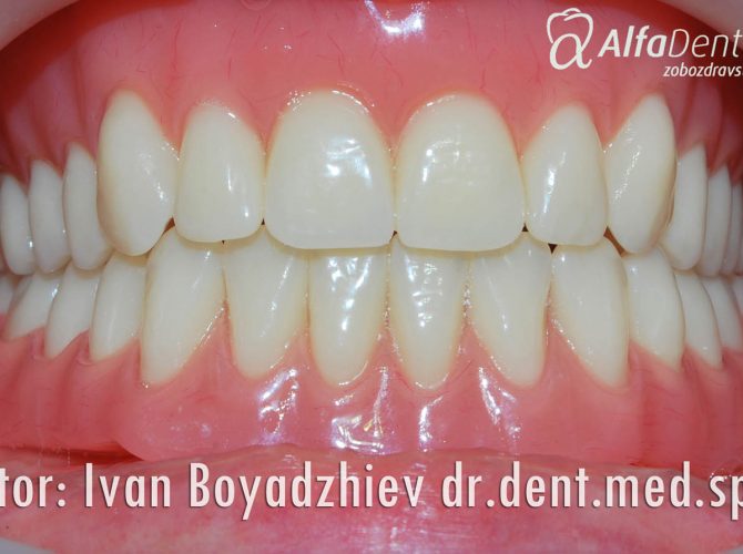 snemna-implan-p2-3